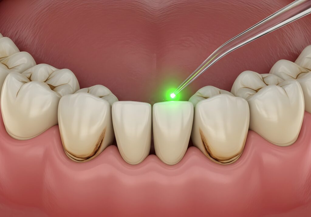 Pain-Free Dentistry with Advanced Dental Lasers: The Future of Comfortable Care