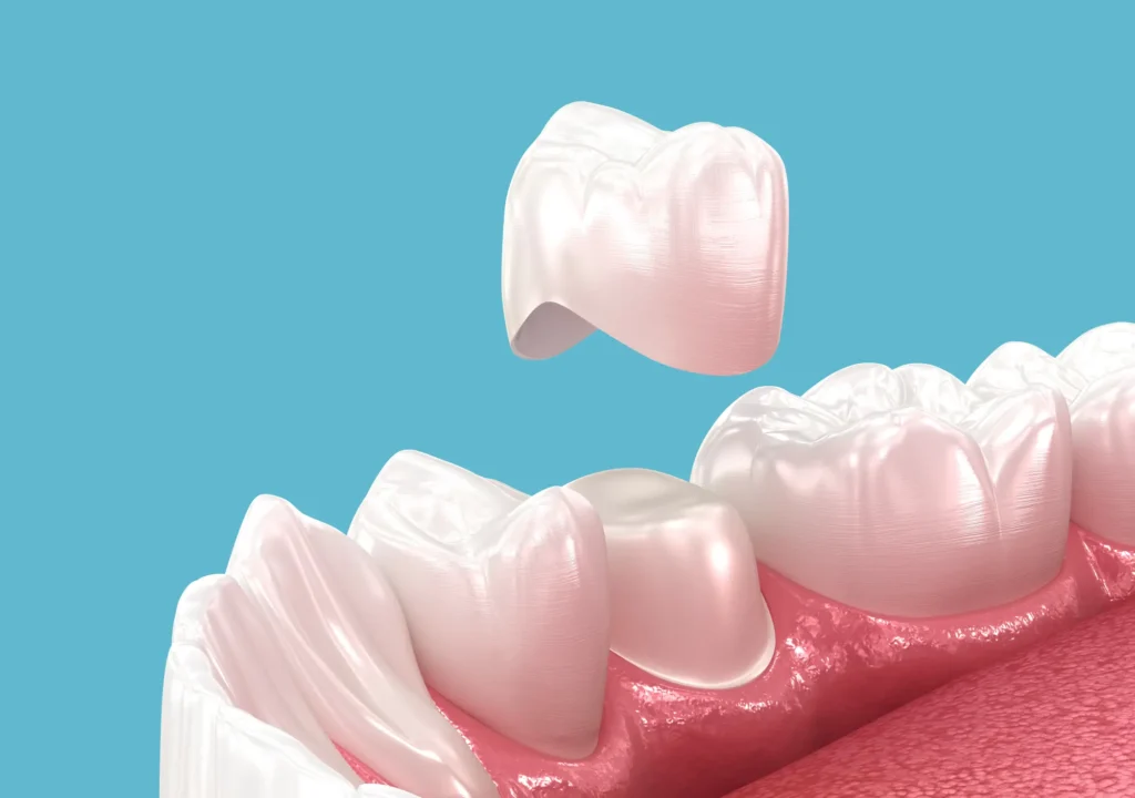 Same-Day CEREC Crowns: The Single-Visit Solution for Comfortable, Convenient Care