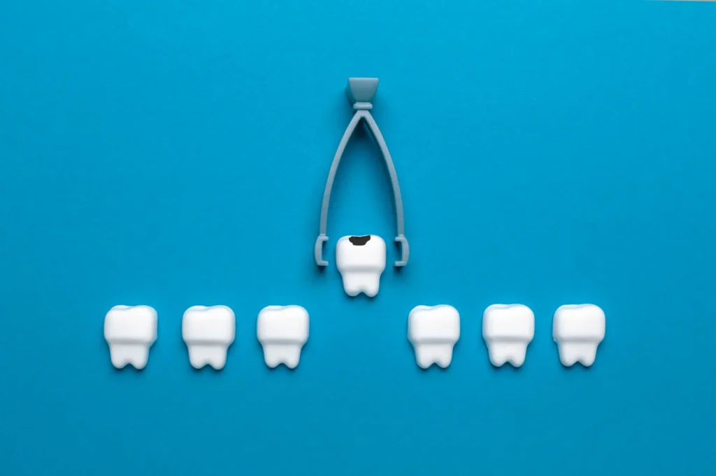 Tooth Extractions: A Gentle Approach to Necessary Oral Surgery